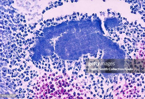 This micrograph depicts histopathologic changes due to the gram-positive organism, Actinomyces israelii, 1971. Image courtesy CDC/Dr. Lucille Georg. .