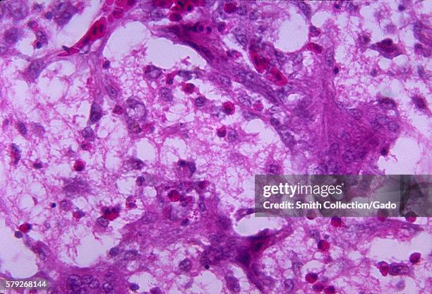 These encephalitic changes found in a 2 week old chicken brain were due to the fungal organism Ochroconis gallopavum, formerly Dactylaria gallopava,...