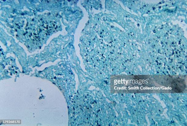 This micrograph depicts histopathologic changes associated with Histoplasmosis of the lung using methenamine silver stain, 1964. Here the yeast forms...