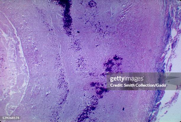 This partially calcified fibrocaseous nodule depicts the histopathologic changes associated with Histoplasmosis of the lung, 1973. Histoplasma...