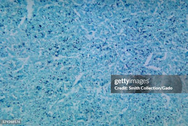 This micrograph depicts histopathologic changes associated with Histoplasmosis of the lung using methenamine silver stain, 1965. Here the yeast forms...