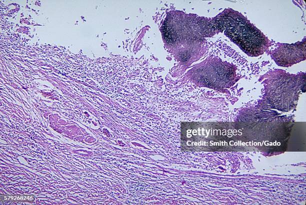 Histopathologic changes of the toe due to Madurella spp. A soil-inhabiting fungal organism, 1965. Some Madurella spp. Are a cause of mycetoma, a...