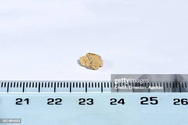 Kidney Stone Ruler Renal Calculi Photos and Premium High Res Pictures - Getty Images