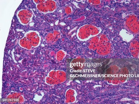 Glomerulonephritis, light micrograph Glomerulonephritis, light micrograph