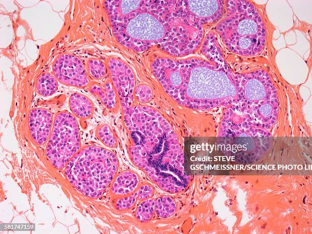 breast cancer, light micrograph - weibliche brust fotos stock-fotos und bilder