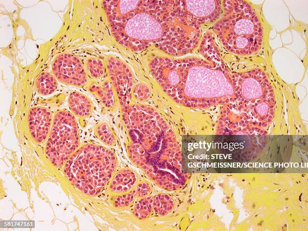 breast cancer, light micrograph - light micrograph stock pictures, royalty-free photos & images