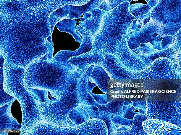 osteoporotic bone, artwork - osteoporose stock-grafiken, -clipart, -cartoons und -symbole