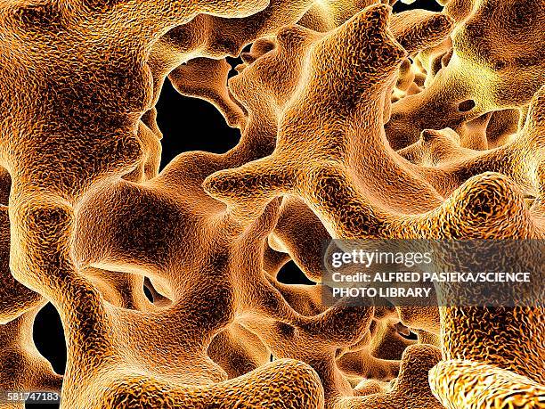 stockillustraties, clipart, cartoons en iconen met osteoporotic bone, artwork - osteoporose