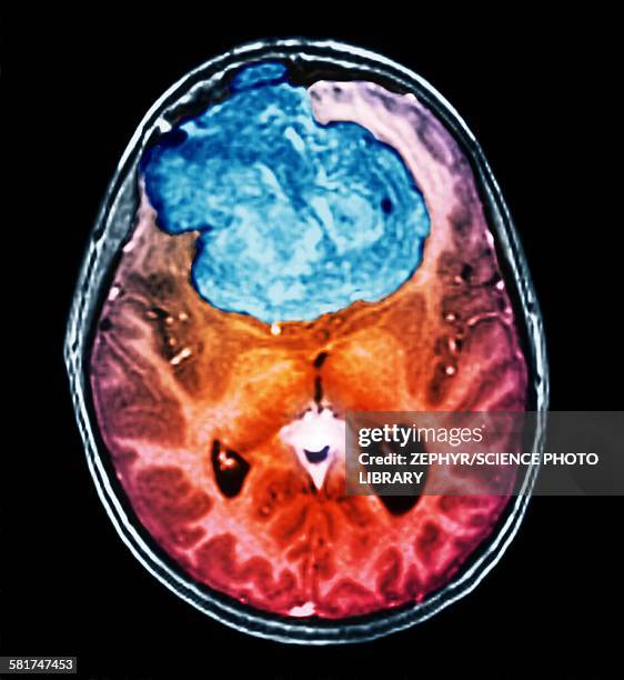 benign brain tumour, ct scan - benign tumor imagens e fotografias de stock