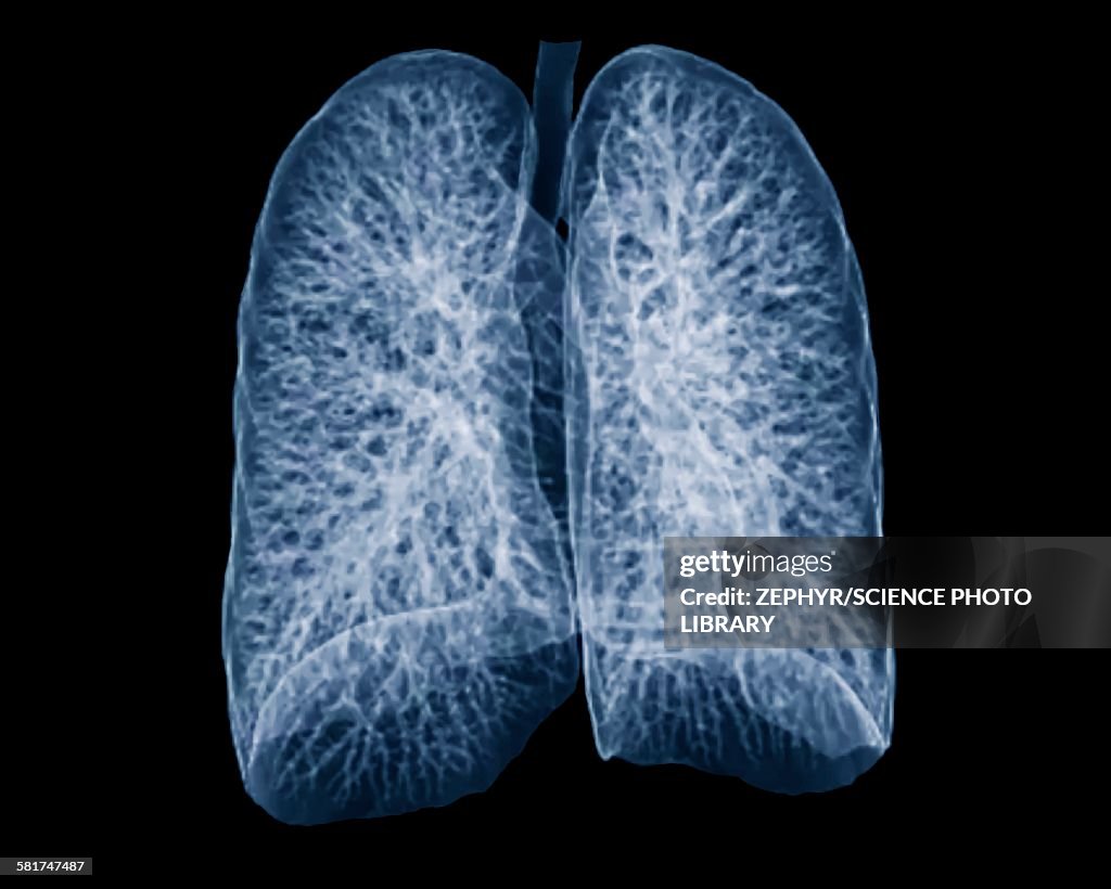 High Resolution Ct Healthy Lungs Ct Scan High-Res Stock Photo - Getty Images