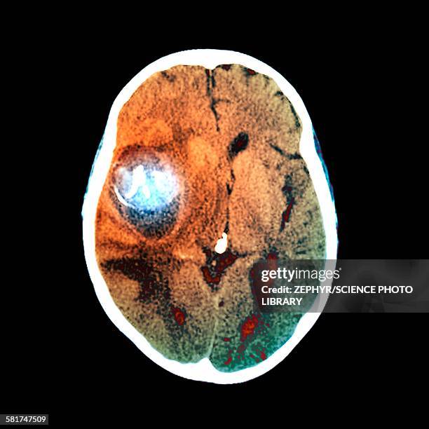 aneurysm, ct scan - brain aneurysm scan stock pictures, royalty-free photos & images