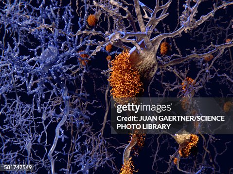 Brain nerve cells affected by alzheimers Brain nerve cells affected by alzheimers
