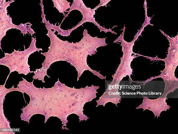 breast cancer cells, sem - micrografía electrónica escaneadora fotografías e imágenes de stock