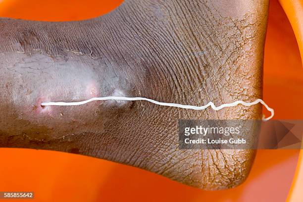 Patient with a guinea worm emerging, at the Savelugu Case Containment Center.
