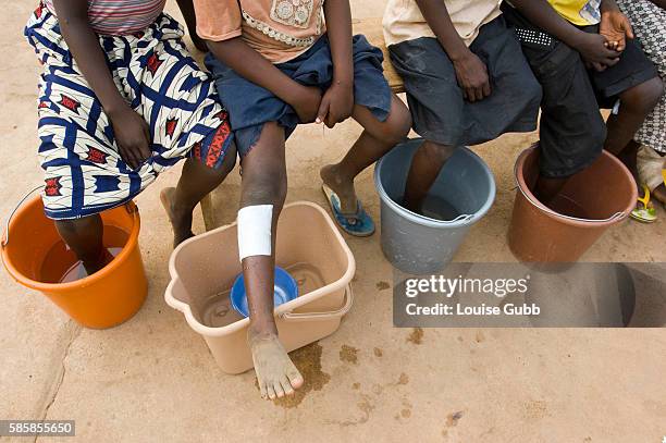 Patients with guinea worms emerging soak their feet in cold water to hasten the painful emergence, at the Savelugu Case Containment Center