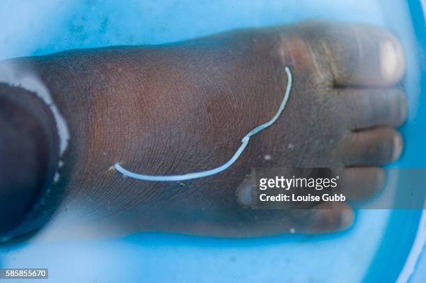 Patient with a guinea worm emerging, at the Savelugu Case Containment Center. The foot is soaked in cold water to coax the worm out.