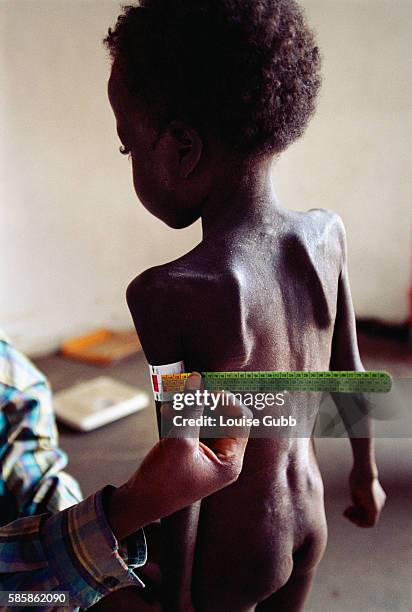 Chinengy, a malnourished refugee, has her upper arm circumference measured to show that she is suffering from severe malnutrition, at a Medecins Sans...