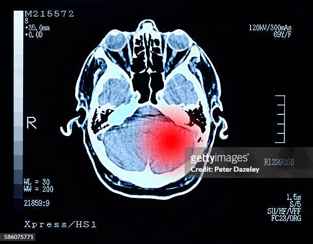 brain damage tumour headache - lesão cerebral - fotografias e filmes do acervo