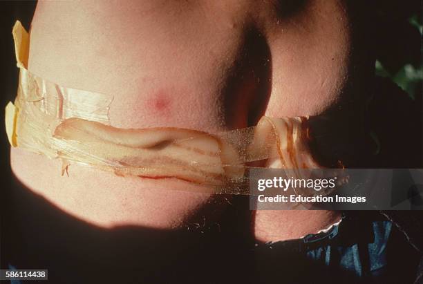 Human botfly large maggots treatment with bacon on Arnold NewmanÕs rump, Costa Rica Dermatobia hominis Life history of human botfly is insidious....