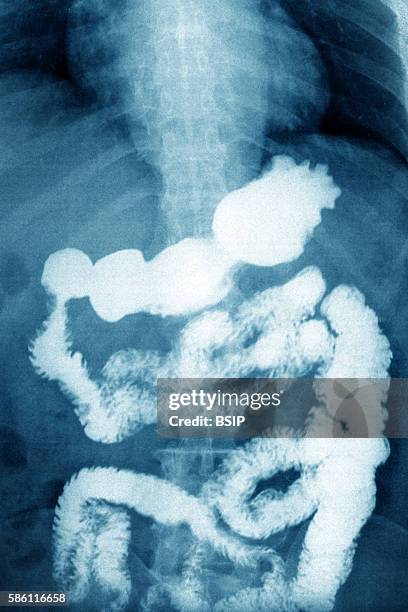 Frontal x-ray examining gastrointestinal transit.