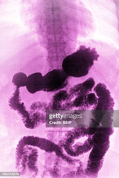 Frontal x-ray examining gastrointestinal transit.