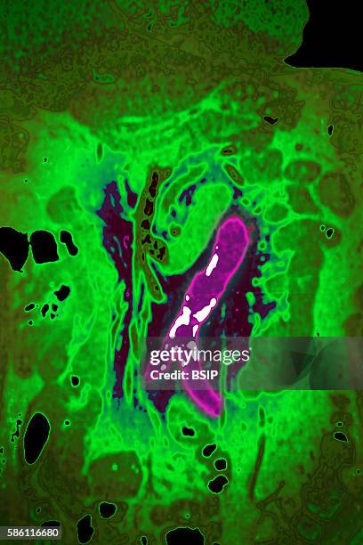 Atheromatous calcifications of the abdominal aorta and its branches Frontal section abdominal CT scan.