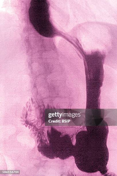 Frontal upper gastrointestinal series.