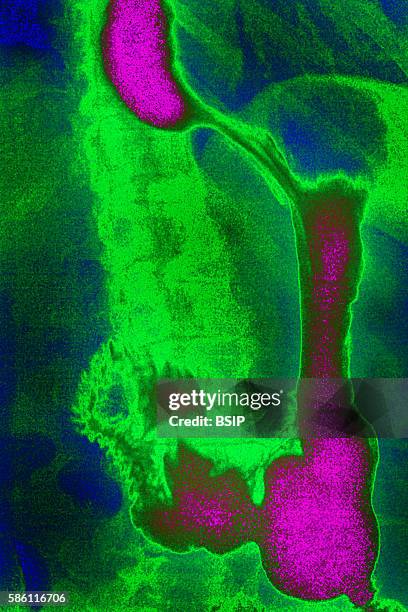 Frontal upper gastrointestinal series.