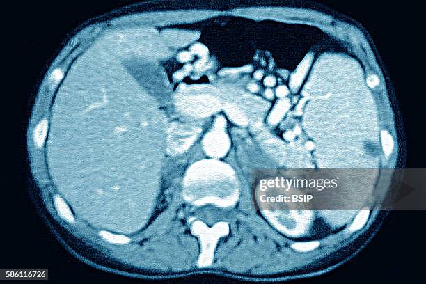 Spleen infarction seen on a radial section CT scan of the abdomen.