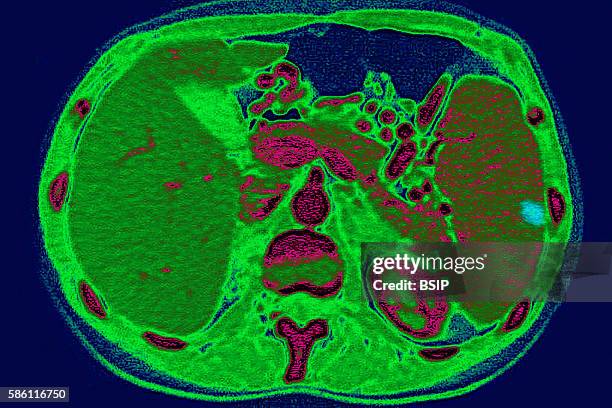 Spleen infarction seen on a radial section CT scan of the abdomen.