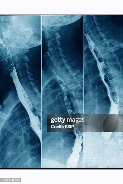 Ray exam of the digestive tract, seen in 3 sagittal-plane views.