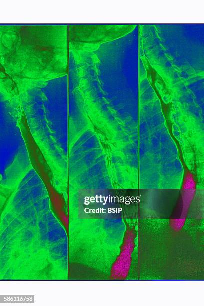 Ray exam of the digestive tract, seen in 3 sagittal-plane views.