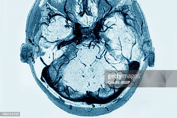 Cerebral venous thrombosis of the left transverse sinus Radial section brain CTA scan.