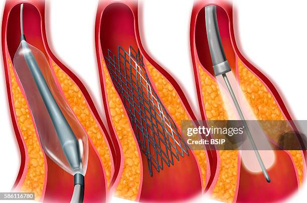 Treating stenosis with angioplasty, balloon stent laser .