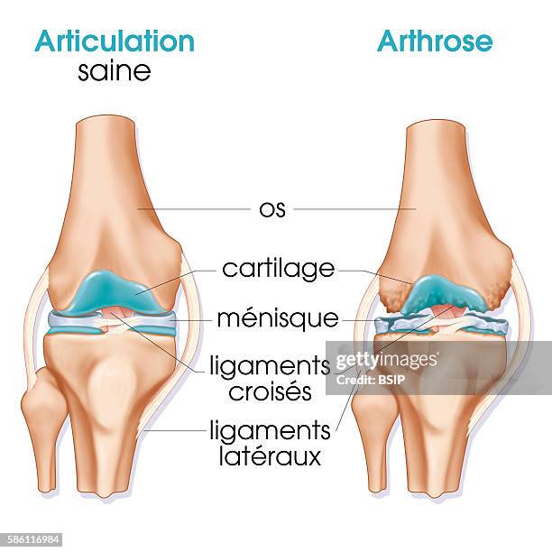 Illustration of the joint in a healthy knee and a knee showing signs of osteoarthritis .