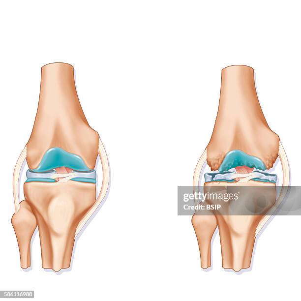 Illustration of the joint in a healthy knee and a knee showing signs of osteoarthritis .