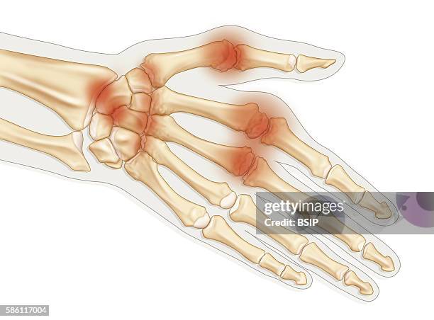 Illustration of a hand suffering from rheumatoid arthritis, with a deterioration of the surface of the bone and cartilage, thickening of the synovial...