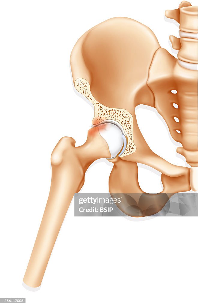 Femoroacetabular impingement