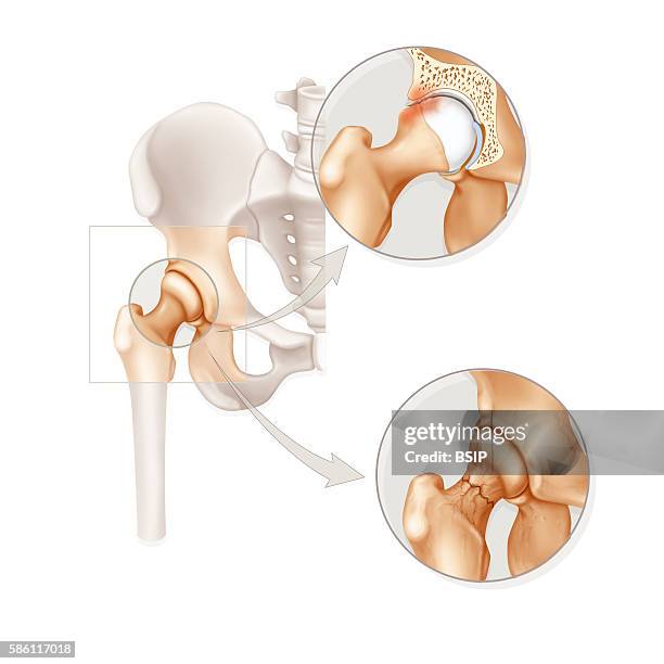 Illustration of the two pathologies in the hip : -femoroacetabular impingement : presence of a bump of the upper front part of the femoral neck,...