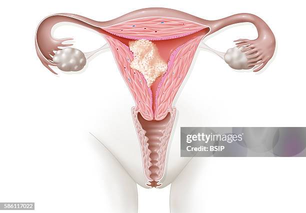 Illustration of cancer of the uterus . The tumor has reached the muscle of the uterus but not the cervix.