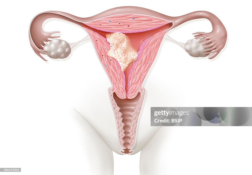 Endometrial cancer, drawing