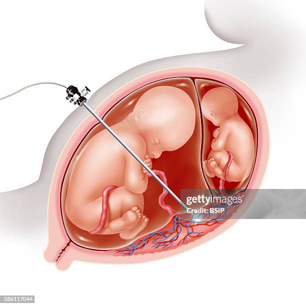 Illustration of laser therapy in twin-to-twin transfusion syndrome. This in utero microsurgery involves the coagulation of placental anastomses...