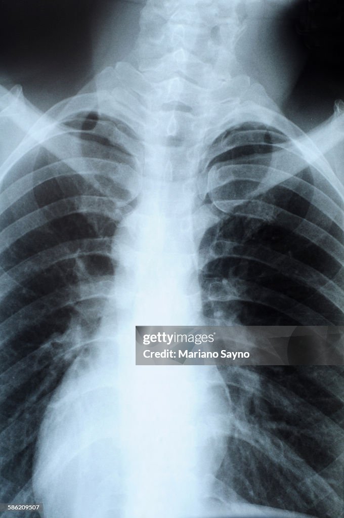 Bones on Xray
