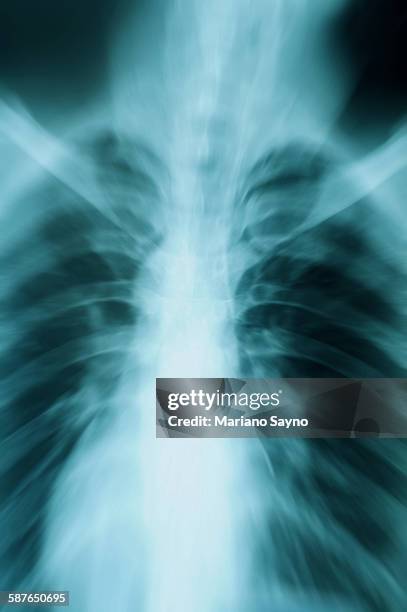 bones on xray - primary bronchus stock pictures, royalty-free photos & images