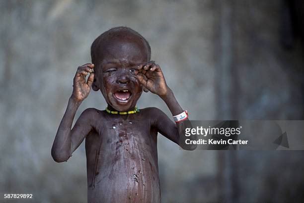 Child famine victim in a feeding center.