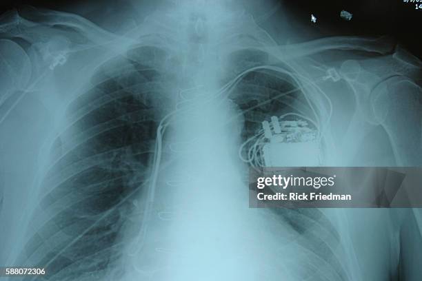 Pacemaker Person 1,414 Pacemaker Images Stock Photos, High-Res Pictures, and Images ...