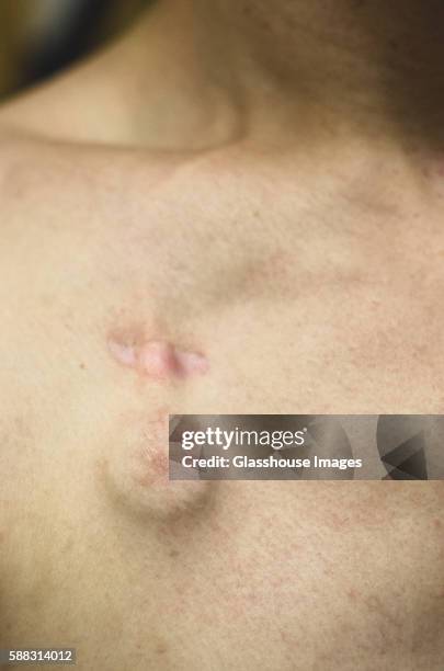 medical chemotherapy port under skin on chest of young man - port males chemo stock-fotos und bilder