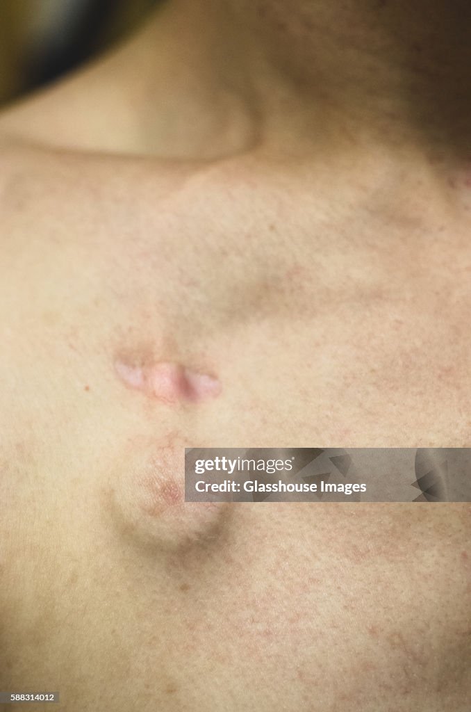 Medical Chemotherapy Port Under Skin On Chest Of Young Man High