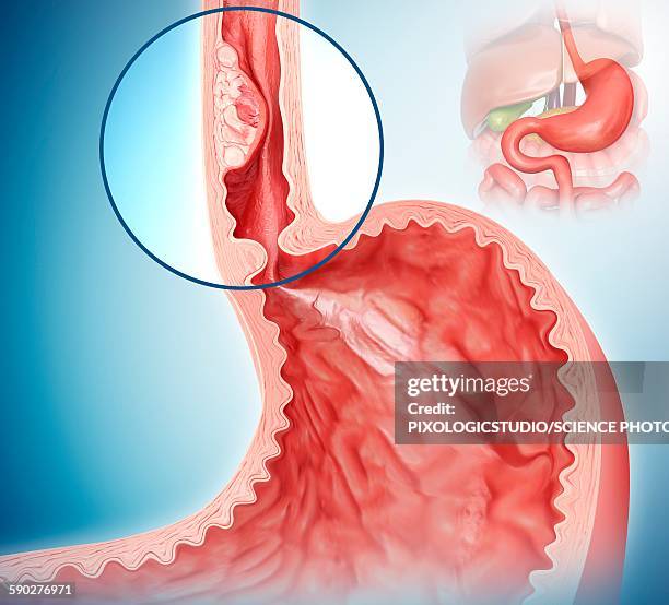 stockillustraties, clipart, cartoons en iconen met oesophageal cancer, illustration - slokdarm