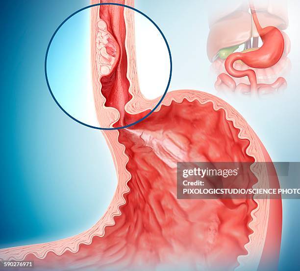 oesophageal cancer, illustration - oesophagus stock illustrations